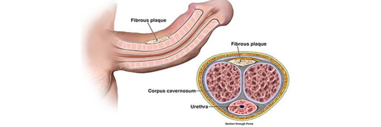 kidney stone disease 1